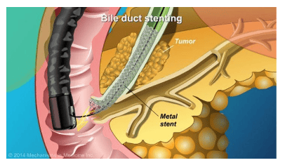 
Đặt stent kim loại giải áp mật qua ERCP
