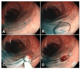 
Polyp to được cắt bằng kỹ thuật sinh thiết lạnh
