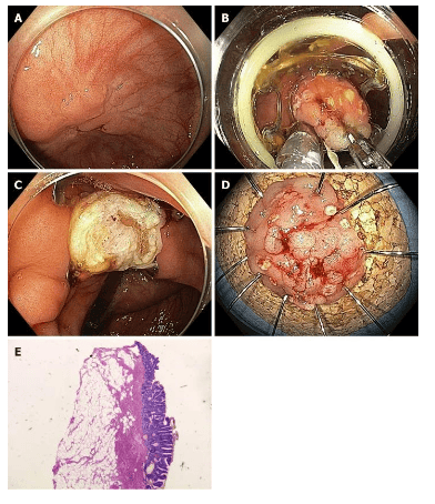 
Cắt bỏ toàn bộ độ thành ống tiêu hóa chữa polyp qua nội soi với thiết bị cắt toàn bộ các lớp ống tiêu hóa.
