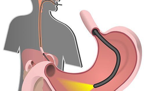 Chuẩn bị và theo dõi bệnh nhân khi tiến hành nội soi mật tụy ngược dòng