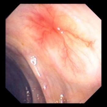 Injury to gastrointestinal blood vessels