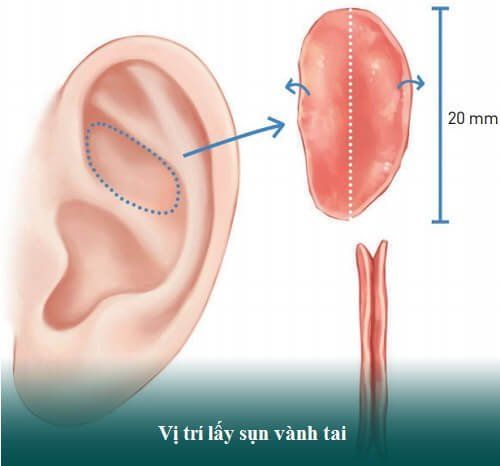 
Bác sĩ có thể lấy mô sụn từ tai để tiến hành kỹ thuật nâng mũi bọc sụn
