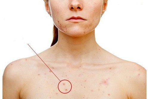 Acne on the chest: Causes and treatment