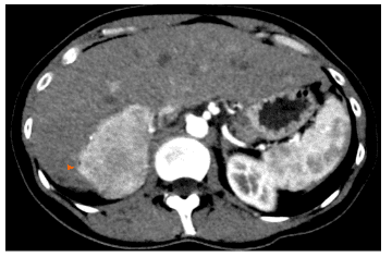 
Angiomyolipoma ở một phụ nữ 33 tuổi khỏe mạnh: Chụp cắt lớp vi tính ổ bụng trên pha động mạch cho thấy một khối u đặc tăng mạch khu trú ở đoạn sau bên phải (đầu mũi tên).
