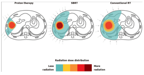 The role of radiotherapy in HCC