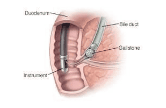 
Thời gian thông nhú kéo dài là yếu tố nguy cơ của viêm tụy sau ERCP
