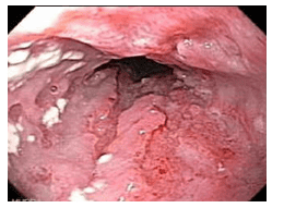 
Hình ảnh nấm Histoplasma ở thực quản
