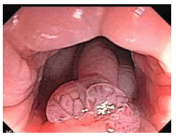 
Một trường hợp nhiễm Histoplasma gần ống hậu môn
