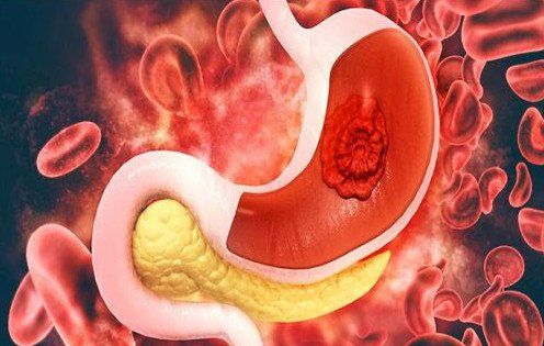 Precancerous mucosal lesions of the gastrointestinal tract