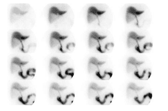 
Hình ảnh scintigraphy trong viêm túi mật cấp tính
