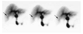 
Scintigraphy trong viêm túi mật cấp tính
