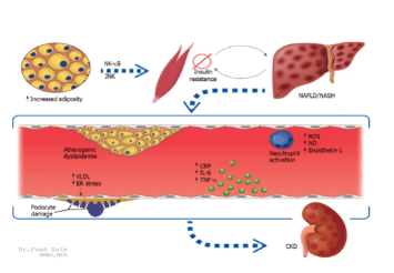 Hepatic risk factors associated with chronic kidney disease in nonalcoholic fatty liver disease