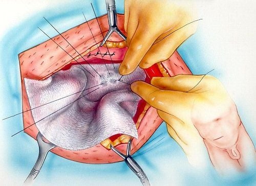 
Phẫu thuật thoát vị bẹn bằng phương pháp Bassinia
