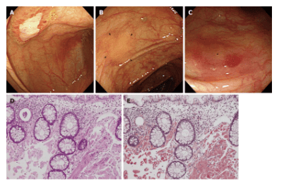 
Biểu hiện trên nội soi đại tràng và mô bệnh học của bệnh amyloidosis Sinh thiết gan
