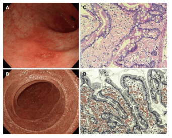 Amyloidosis - Prevalence and classification