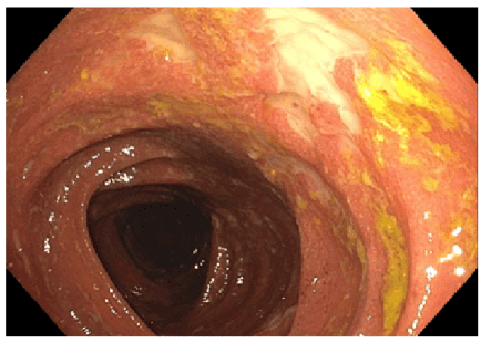 
Biểu hiện trên nội soi đại tràng của bệnh amyloidosis
