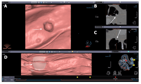 
Hình ảnh nội soi đại tràng ảo: Hình ảnh hai và ba chiều của polyp
