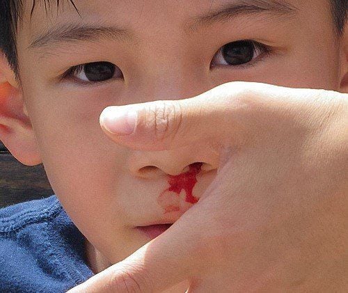 When is a nosebleed in a child serious?