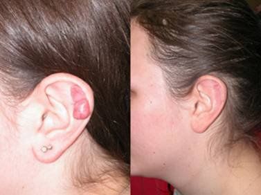 Keloid injection can achieve quick and significant improvement.