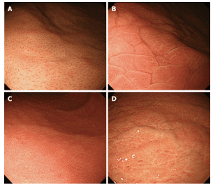 Standard narrow band versus magnification endoscopy for the diagnosis of Helicobacter pylori infection and precancerous conditions of the stomach