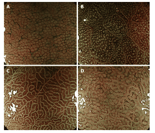 Standard narrow band versus magnification endoscopy for the diagnosis of Helicobacter pylori infection and precancerous conditions of the stomach