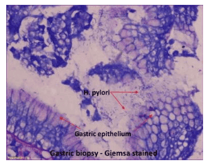 
Hình ảnh biểu mô dạ dày và vi khuẩn H.Pylori
