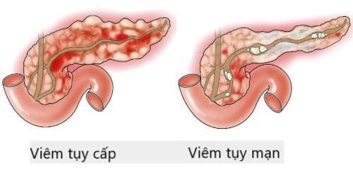 
Hình ảnh viêm tuỵ cấp và viêm tụy mạn
