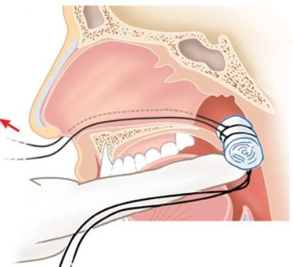 
The technique of inserting the posterior nasal wick needs to be done carefully
