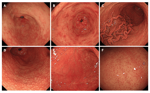 
Kết quả nội soi về phân loại Kyoto. A: Viêm chuyển sản ruột; B: Đỏ như bản đồ; C: Các nếp gấp phì đại ; D: Tổn thương dạng nốt; E: Đỏ da lan tỏa; F: Sự sắp xếp đều đặn của các tiểu tĩnh mạch RAC trong hình ảnh được phóng đại thấp
