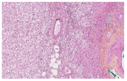 
Hình ảnh nhuộm Hematoxylin-Eosin-Saffron của u mạch gan. Có ba thành phần của u mạch gan: mạch (*), tế bào mỡ (**) và nhiều tế bào biểu mô (***). Có ít tế bào gan hơn (†) (độ phóng đại × 10).
