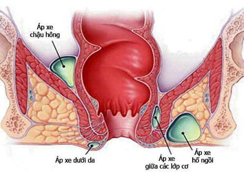 Is it dangerous to have an anal abscess after surgery?