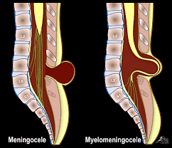 
Siêu âm cột sống trẻ có khối u vùng cùng cụt
