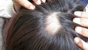 Nguyên nhân và cách khắc phục rụng tóc từng mảng?
