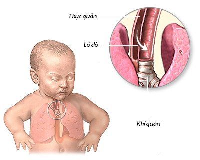 
Với những biến chứng nguy hiểm có thể xảy ra thì việc phẫu thuật đóng lỗ rò thực quản bẩm sinh và tái phát là rất cần thiết
