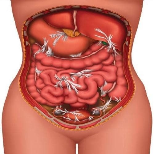 Remove intestinal adhesions after surgery