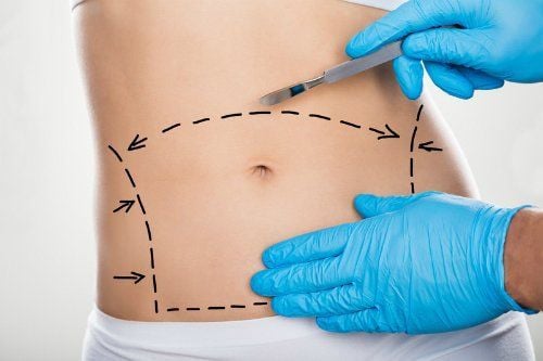 Abdominal skin removal surgery