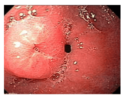 
Nhiễm Histoplasmosis ở tá tràng
