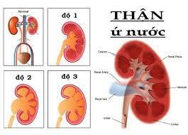 Trẻ 2 tuổi bị nang thận, thận ứ nước độ 2 điều trị thế nào?