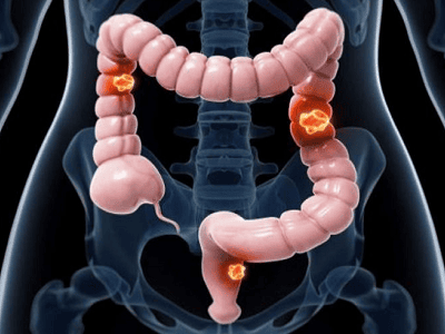 Adjusted risk score-based screening for advanced adenomas and colorectal cancer