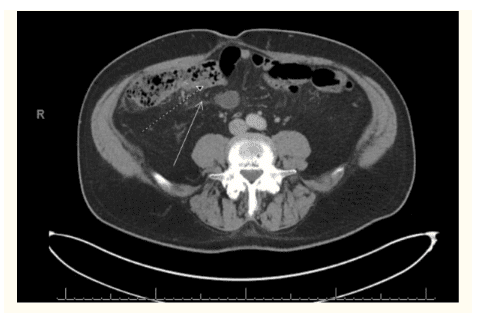 
CT bụng và khung chậu có cản quang (nhìn dọc trục) cho thấy sự thay đổi viêm đáng kể ở vùng hạ sườn phải ở mạc treo tràng bao quanh manh tràng (mũi tên trắng) và dày thành manh tràng (mũi tên chấm).
