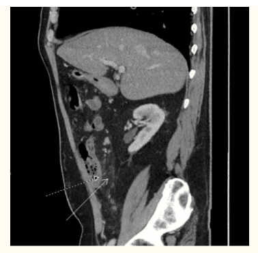 
CT bụng và khung chậu có cản quang (nhìn sagittal) cho thấy sự thay đổi viêm đáng kể ở vùng hạ sườn phải ở mạc treo ruột bao quanh manh tràng (mũi tên trắng) và dày thành manh tràng (mũi tên chấm).
