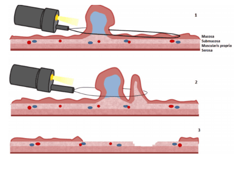 
Lấy quá nhiều mô ở thành đại tràng khi cắt polyp có thể gây nên hội chứng đau bụng cấp
