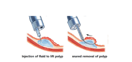 
Kỹ thuật EMR – tiêm vào lớp dưới niêm giúp nâng polyp khỏi lớp cơ giúp hạn chế hội chứng đau bụng cấp sau cắt polyp
