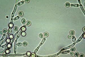 
Sợi tơ nấm Candida (nhiễm Candida mạn tính)
