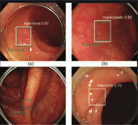 Polyp đại tràng được ghi nhận tự động bằng trí tuệ nhân tạo