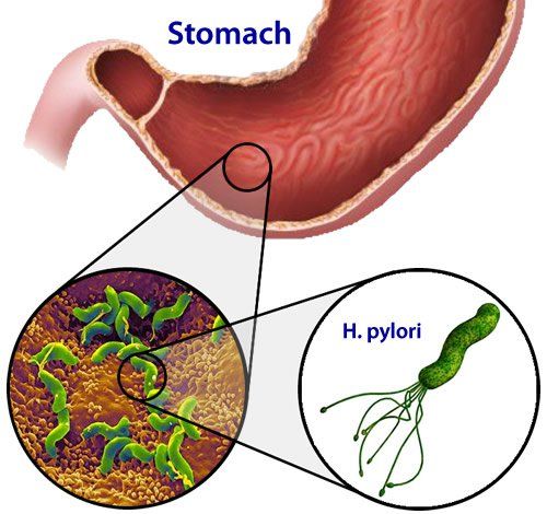 
Sự xâm nhập của vi khuẩn H.Pylori vào niêm mạc dạ dày
