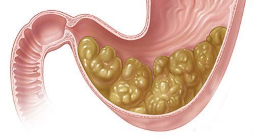 
Bệnh liệt dạ dày làm rỗng dạ dày chậm mà tắc nghẽn cơ học của đường tiêu hóa trên
