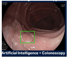 
Phát hiện polyp đại tràng bằng AI
