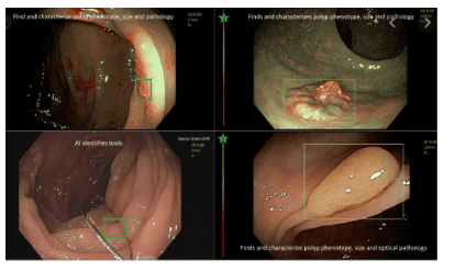 
Trí tuệ nhân tạo giúp tăng tỉ lệ phát hiện polyp cho các bác sĩ
