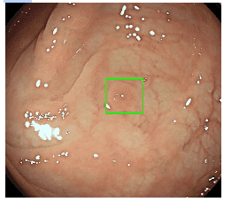 
AI giúp đánh giá bản chất mô học polyp với độ chính xác cao
